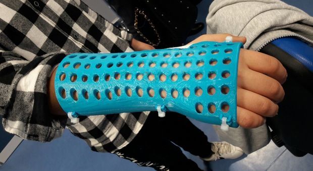 Esoscheletro stampato in 3D invece del gesso: progetto a Napoli