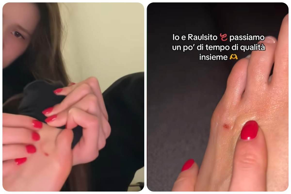 samantha frison piede verme